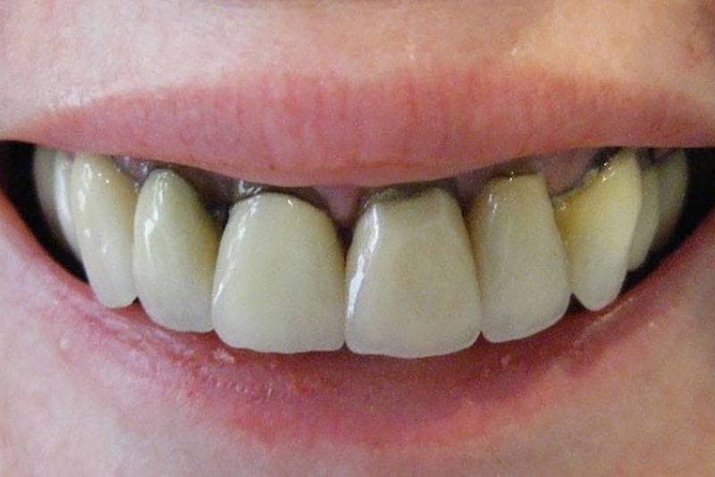 Mão Titan không phù hợp phục hình răng cửa