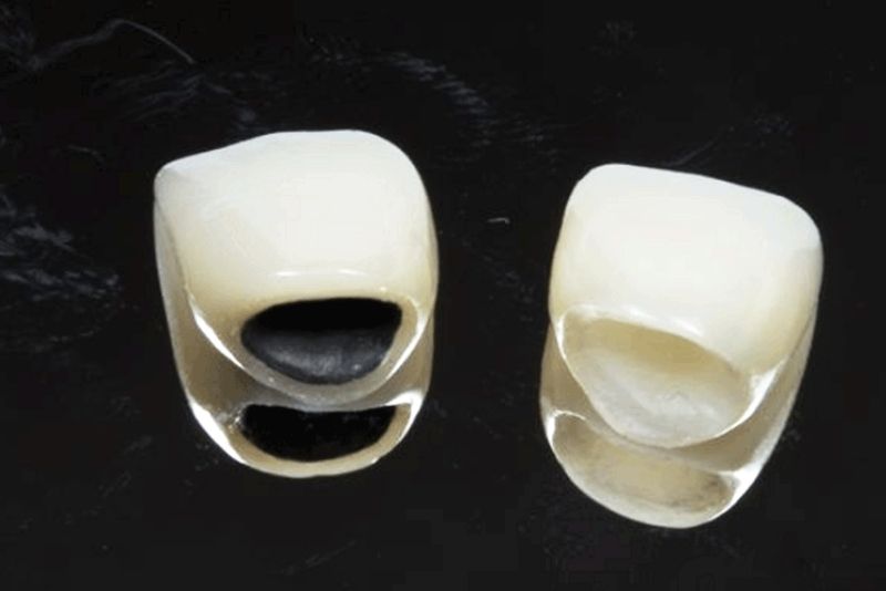 Răng sứ kim loại Titan