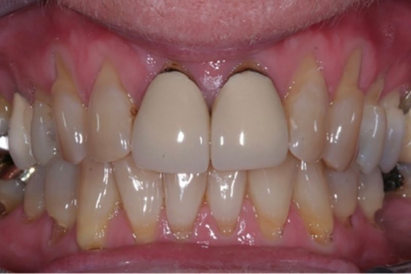 Răng sứ cũ không đảm bảo tính thẩm mỹ