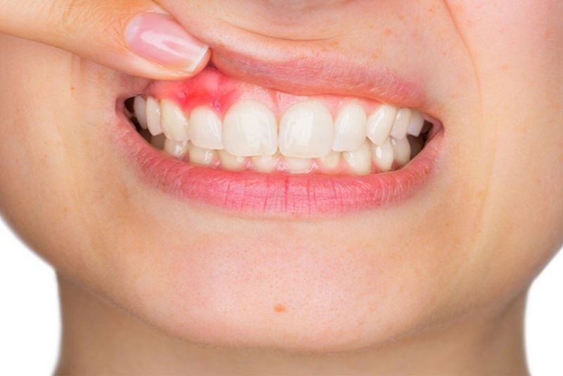 Cần chữa viêm nướu trước khi gắn răng sứ mới