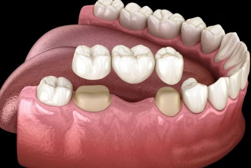 Răng sứ Titan phù hợp bọc răng hàm