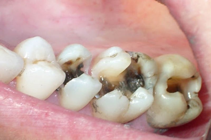 Răng bị mẻ và sâu nhiều