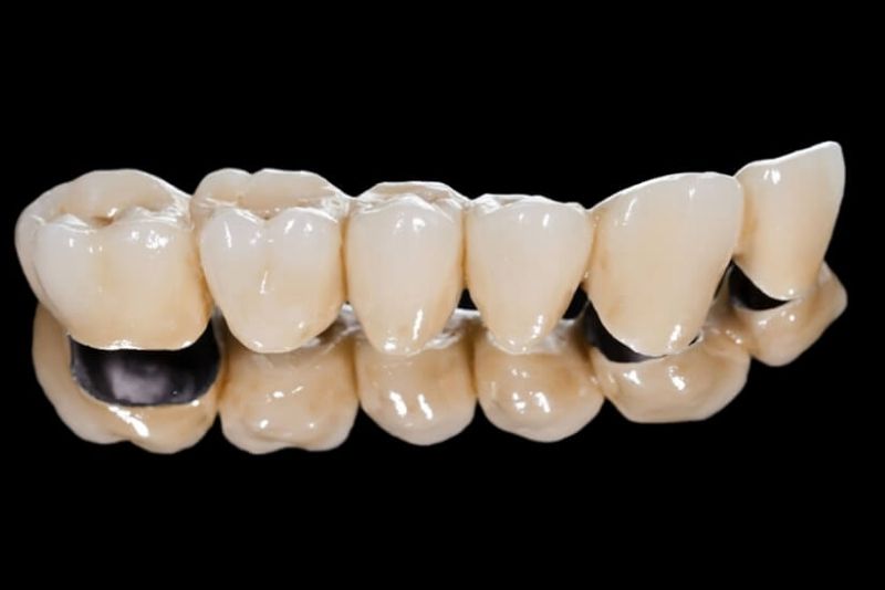 Tuổi thọ của răng sứ titan tùy thuộc vào cách chăm sóc