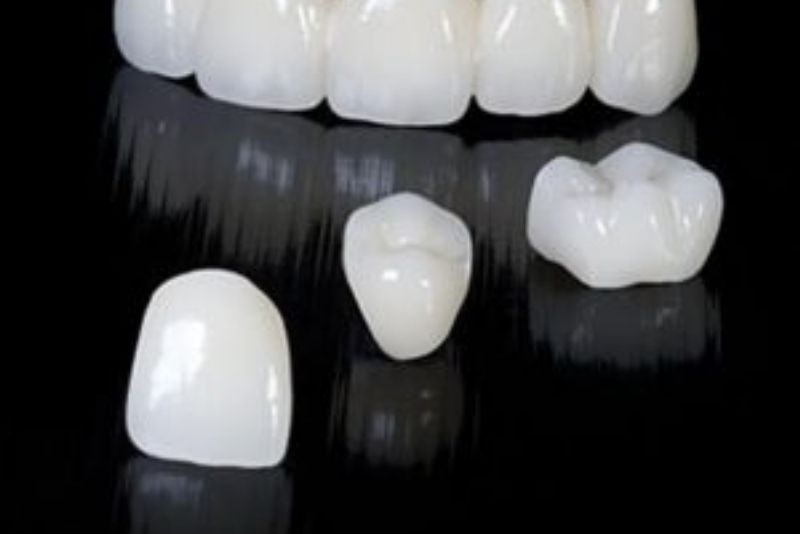 Răng sứ Venus Zirconia là phổ biến nhất