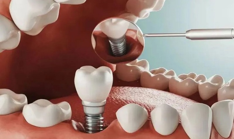 Trồng Implant sau khi nhổ răng giúp duy trì chức năng ăn nhai