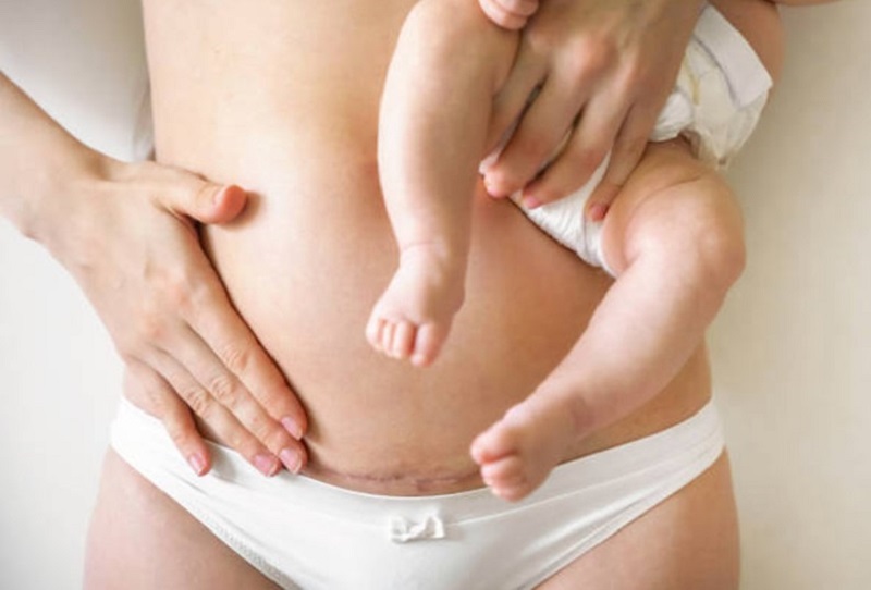 Nên hút mỡ khi đã cai sữa cho bé hoặc khi cơ thể phục hồi ổn định