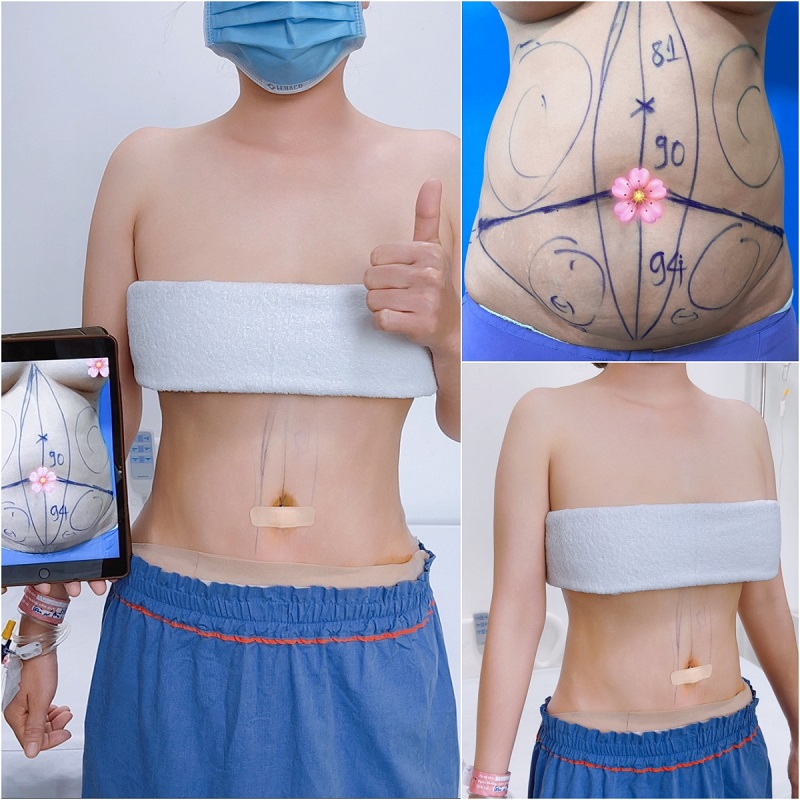 Hút mỡ giúp làm bỏ mỡ thừa sau sinh hiệu quả