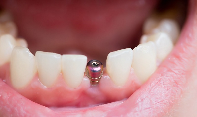 Khách hàng cần được kiểm tra sức khỏe trước khi trồng răng