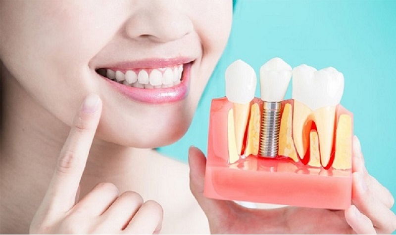 Chất lượng trụ implant ảnh hưởng đến quá trình ăn uống
