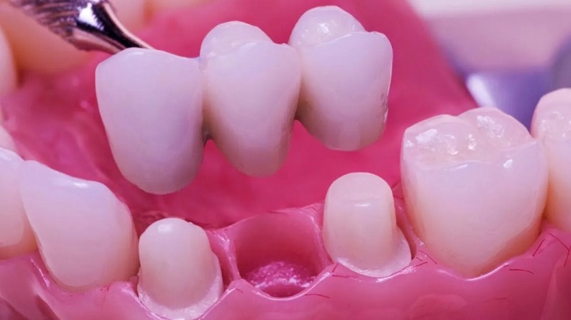 Trồng răng bắc cầu phù hợp với trường hợp răng kế cận còn khỏe mạnh