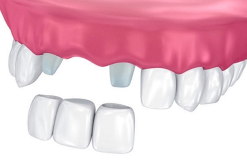 Làm cầu răng sứ trong trường hợp mất 1 răng