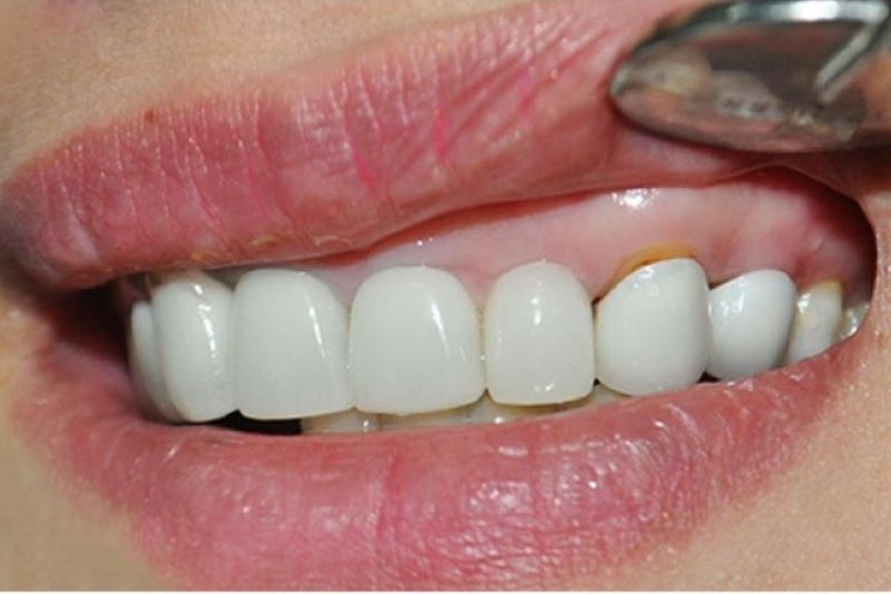 Răng sứ giá rẻ tính thẩm mỹ không cao