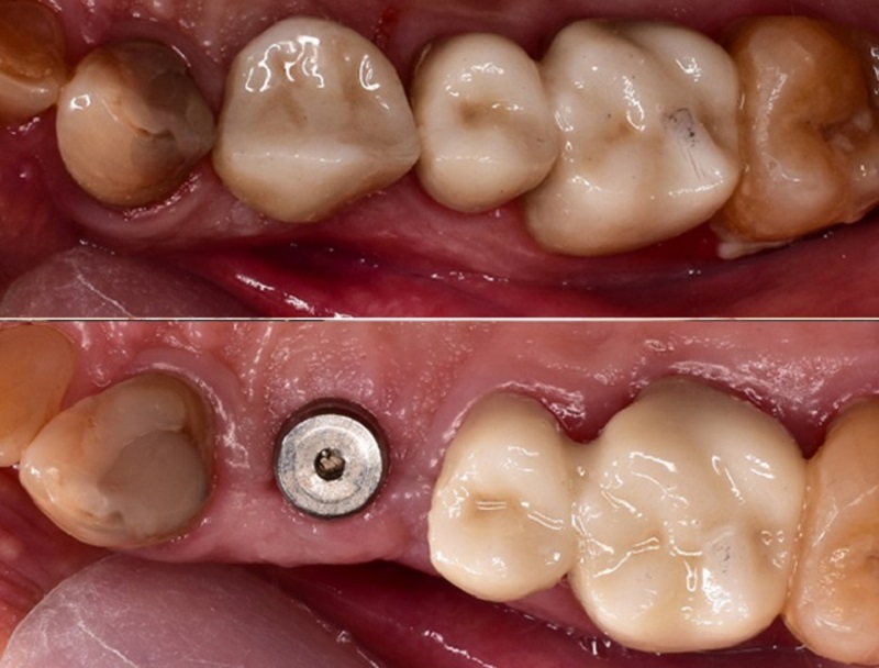 Những người có cơ địa nhạy cảm, xương hàm yếu có thể đau nhức kéo dài