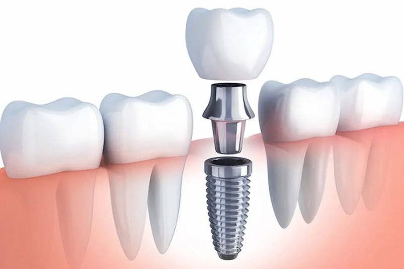 Cắm trụ implant sẽ đau hơn làm cầu răng sứ