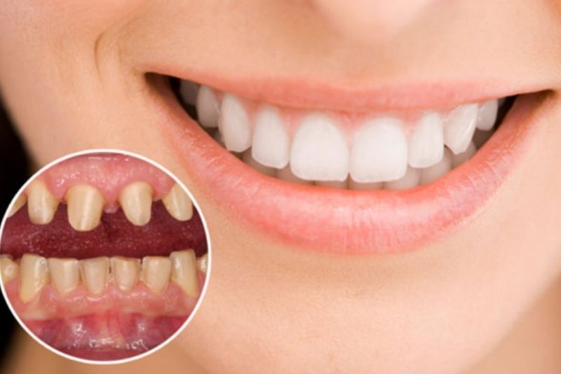 Chỉ nên bọc sứ khi đủ độ tuổi và có chỉ định