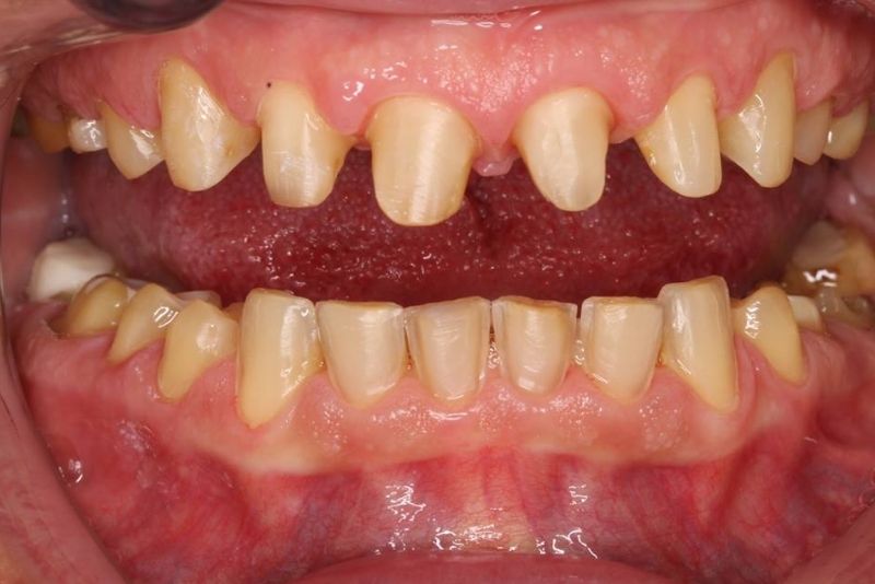 Mài răng quá nhiều