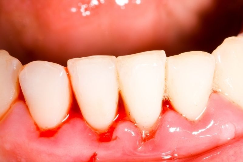 Viêm nướu, hở cổ chân răng