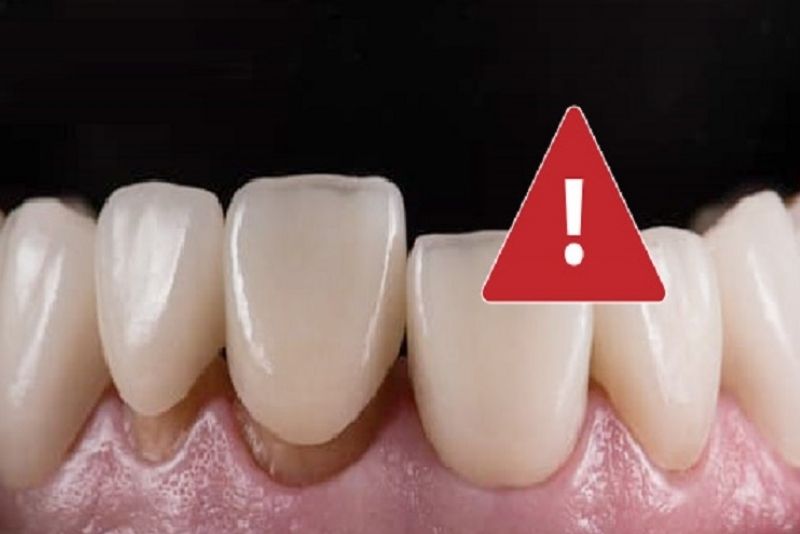 Viền sứ không sát khít