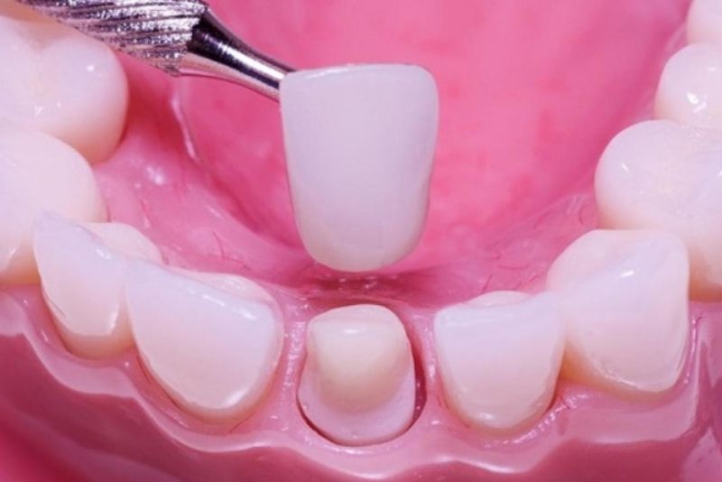 Thay mão sứ mới sát