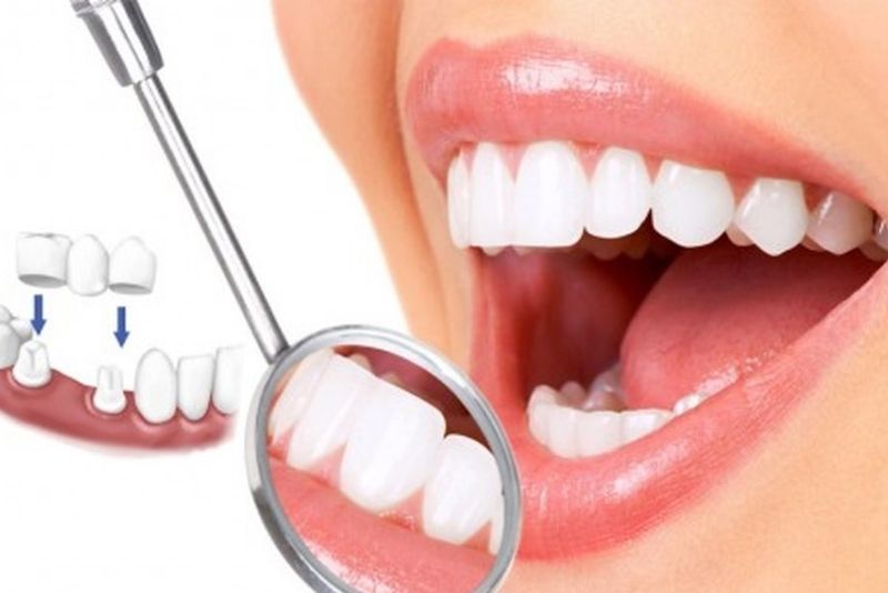 Răng sứ là vật liệu nhân tạo, không bị sâu