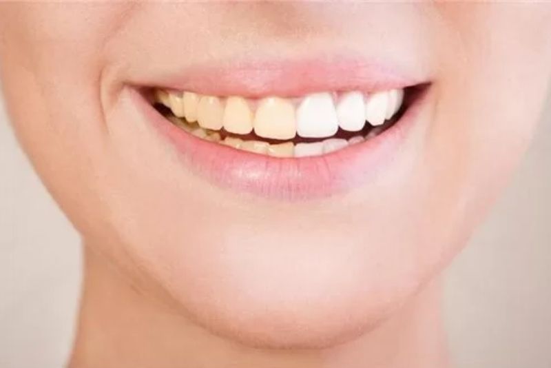 Răng sứ đổi màu