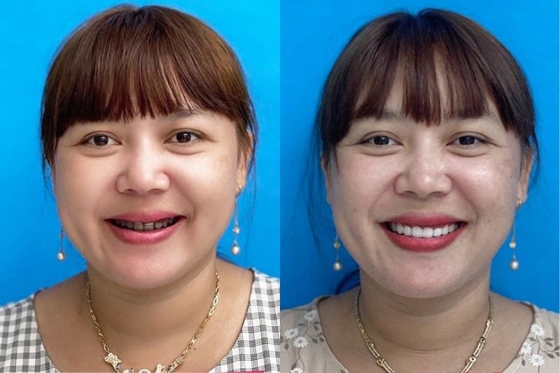 Răng thật có bệnh lý sẽ mất nhiều thời gian hơn