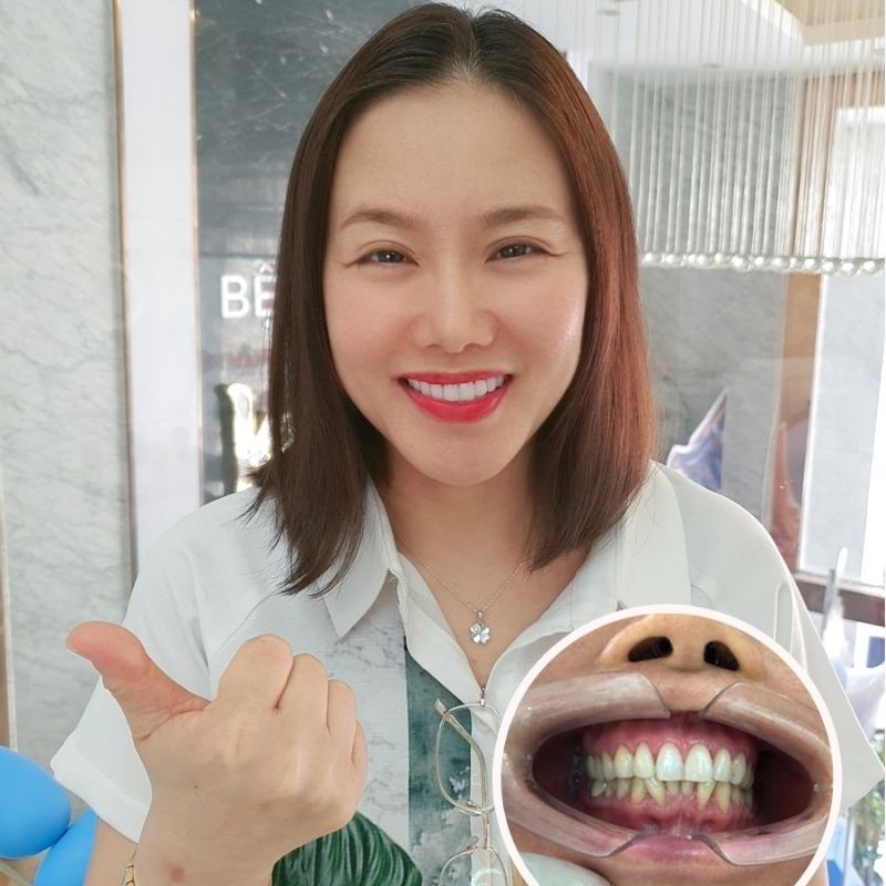 Chỉ nên bọc mão sứ khi đủ tuổi