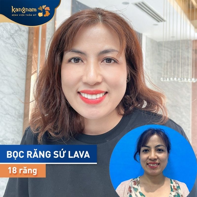 Răng thưa, xỉn màu