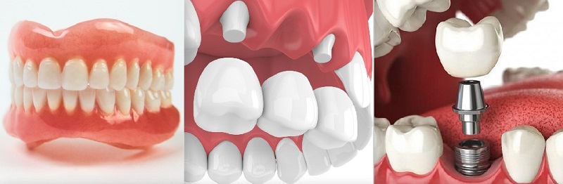 Có nhiều phương pháp trồng răng phổ biến