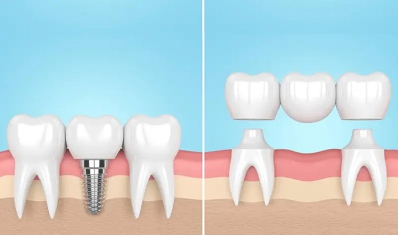 Trồng răng Implant là phương pháp được đánh giá cao hiện nay