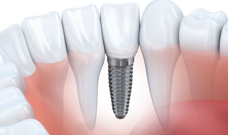 Trồng răng Implant duy trì khả năng ăn nhai tốt và lâu bền