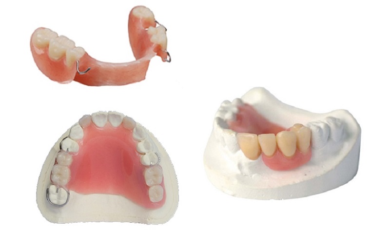 Hàm giả tháo lắp có thể vệ sinh dễ dàng hàng ngày