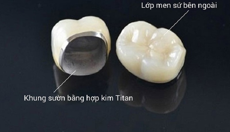 Răng sứ Titan được nhiều người lựa chọn nhờ chi phí hợp lý