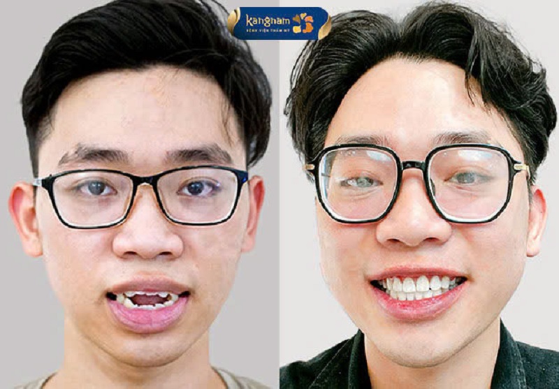 Trồng răng sứ Titan đúng cách giúp đảm bảo tính thẩm mỹ và an toàn cao