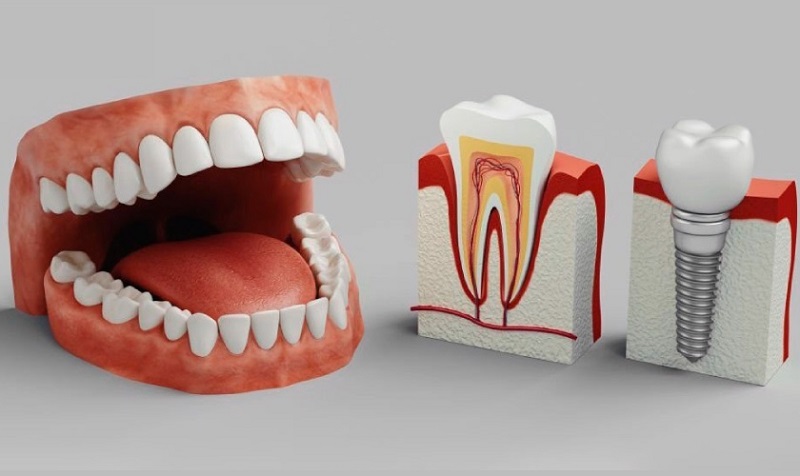 Nên trồng răng Implant khi bị mất răng, hỏng răng 