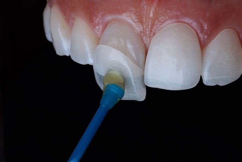 Dán veneer tạm để bảo tồn răng, tăng tính thẩm mỹ