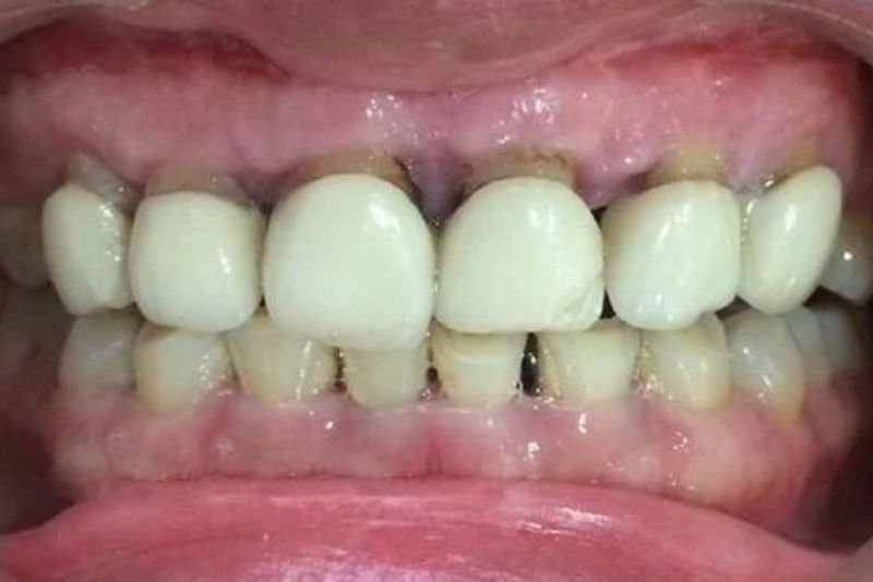 Răng sứ kém chất lượng