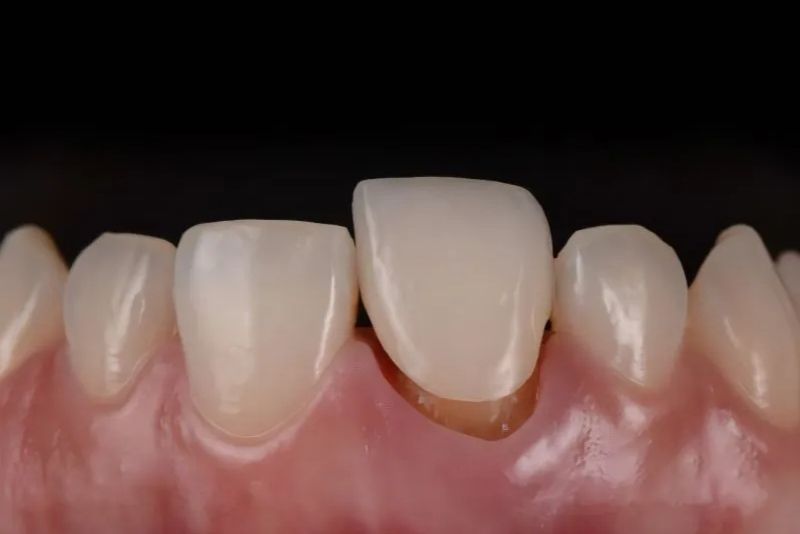 Răng sứ bị lỏng gây cảm giác lung lay