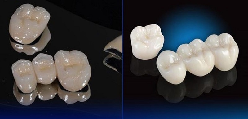 Một số trường hợp có thể cần tháo mão sứ