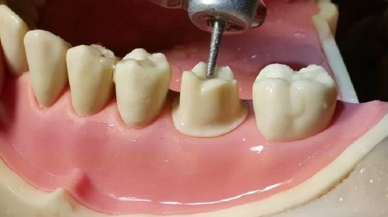 Cảm giác đau nhức có thể xảy ra khi trồng răng