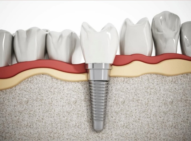 Trồng răng Implant đảm bảo an toàn và hiệu quả cao