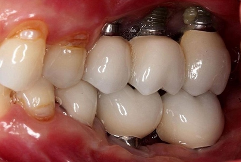 Vùng xung quanh trụ Implant bị nhiễm trùng