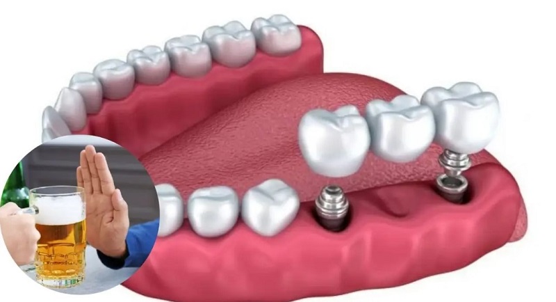 Nên tránh uống rượu bia trước và sau khi trồng răng Implant