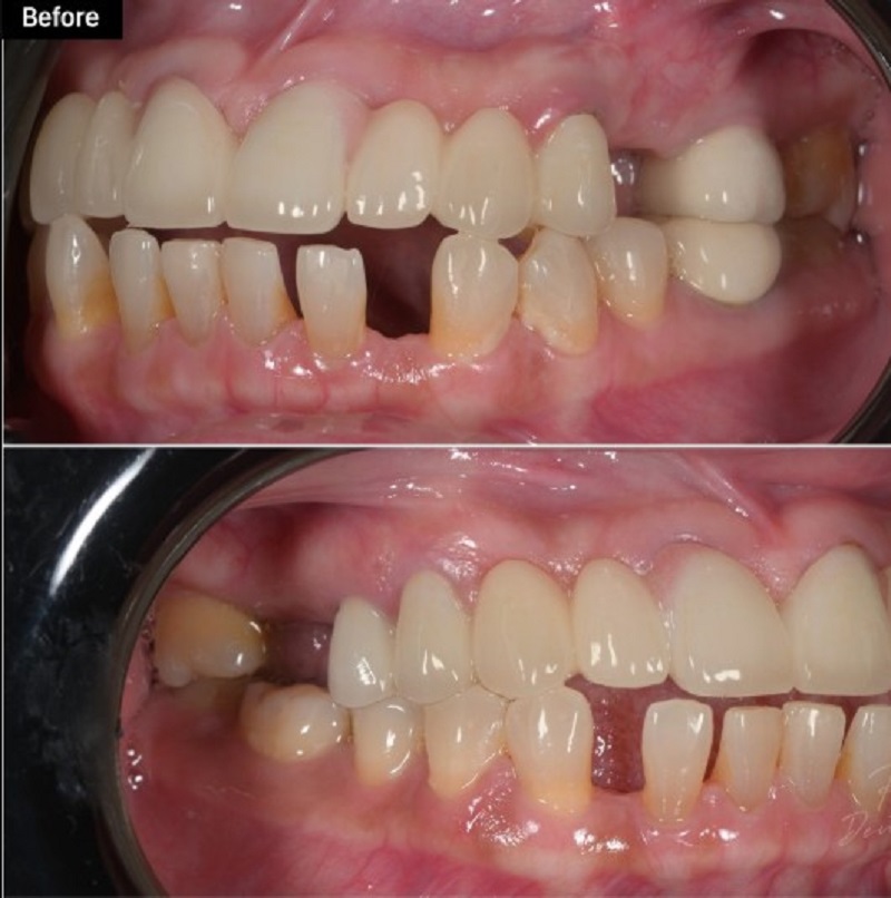 Trường hợp ghép xương hoặc nâng xoang thời gian kiêng rượu bia sẽ lâu hơn