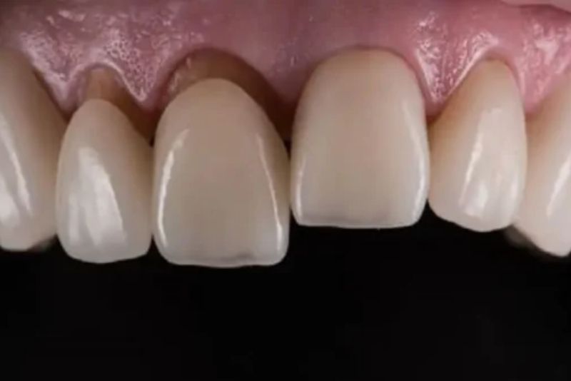 Răng sứ bị hở