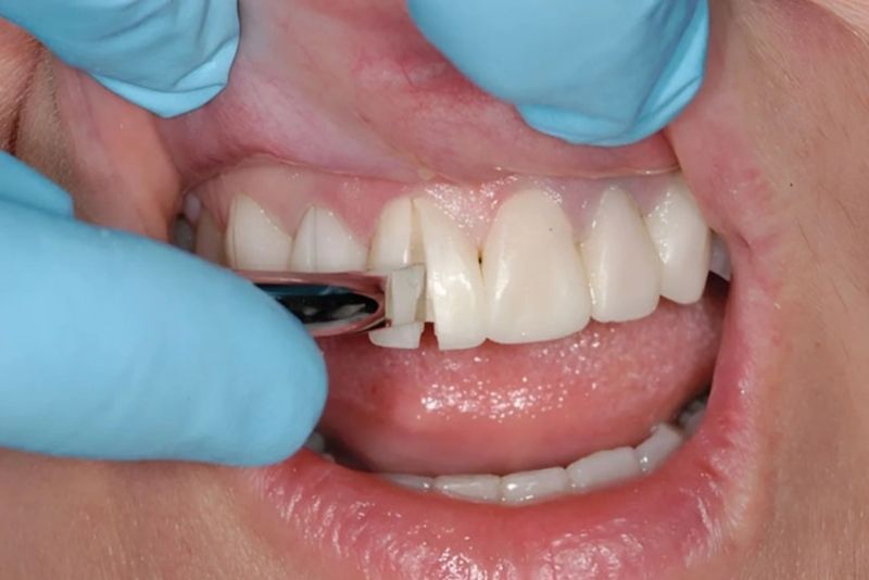 Tháo răng sứ tại nha khoa để đảm bảo an toàn