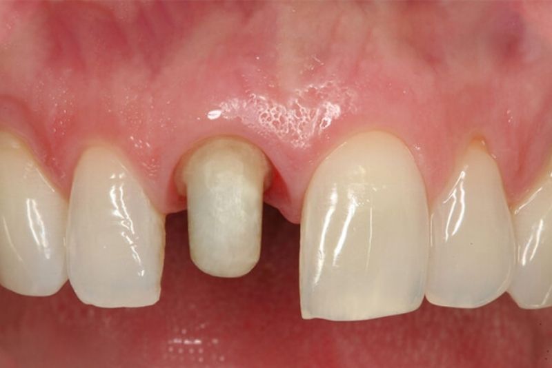 Kiểm tra cùi răng thật sau khi tháo