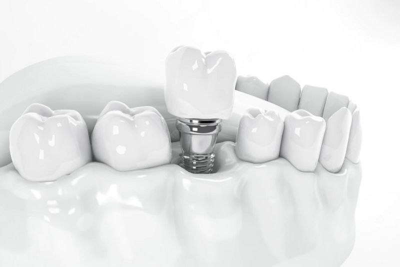 Trồng răng sứ