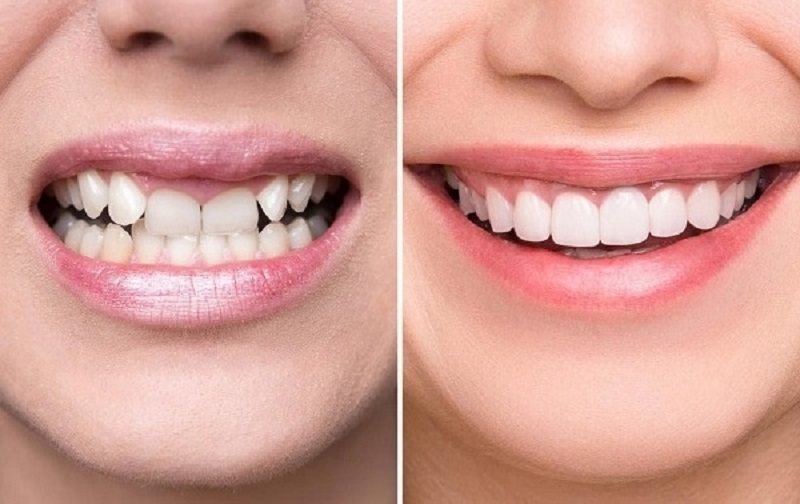 Thời gian răng sứ duy trì được rất lâu