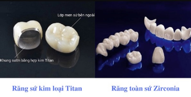 Răng sứ kim loại và răng toàn sứ được nhiều người sử dụng